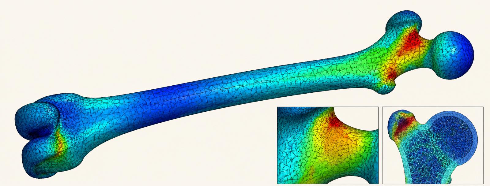 Finite element analysis of a femur showing von Mises stress distribution