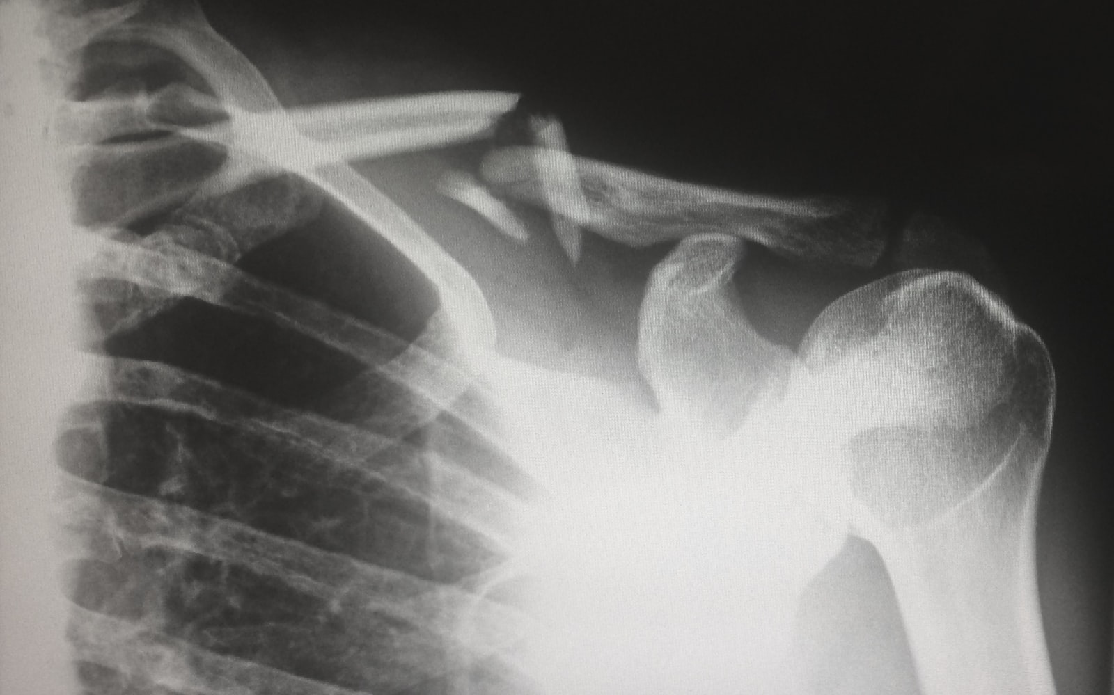 Shoulder X-ray image